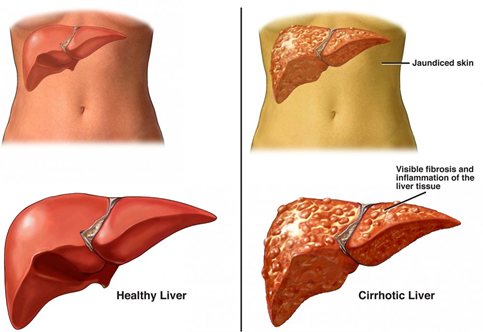 Does steroids cause liver damage